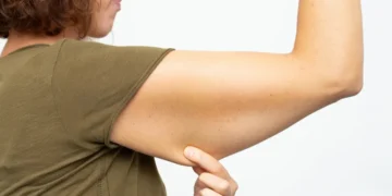 Mulher apontando para a flacidez do braço, ilustrando a necessidade de fortalecimento muscular.