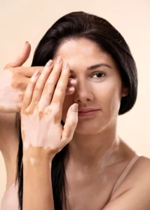 Mulher com vitiligo cobrindo parcialmente o rosto com a mão, mostrando áreas de pele despigmentada.
