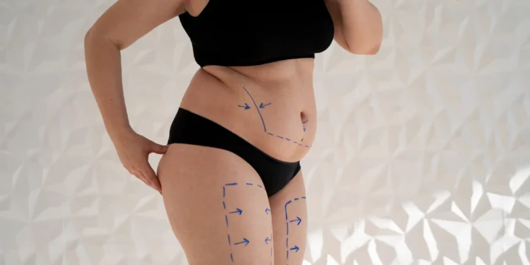 Imagem mostrando marcações azuis no corpo de uma mulher, destacando áreas de gordura localizada